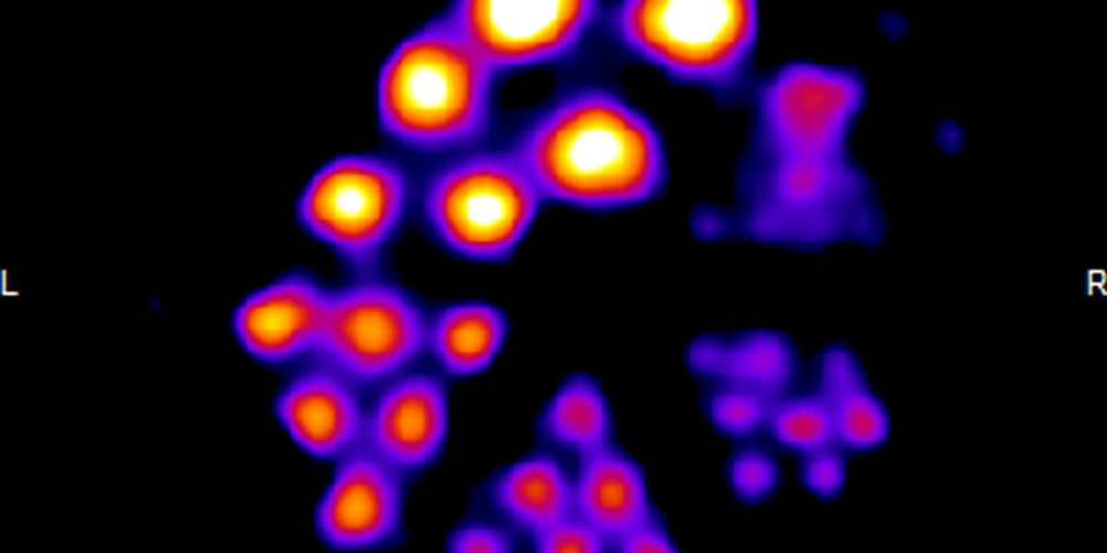 SPECT image of 0.8 mCi of Pb-203 as PbCl2 in solution.  The material was placed in a small device used to gauge resolution capabilities of the imaging camera against the source isotope. Image courtesy: Suzanne E. Lapi and Shefali Saini, UAB